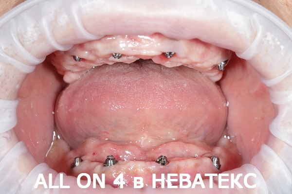 несъемные зубные протезы фото несъемные зубные протезы фото